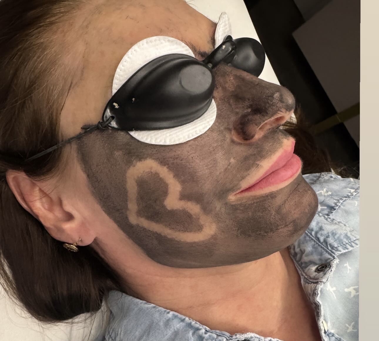 Carbon peeling Piešťany – čierna maska na tvári, Mya Beauty Studio
