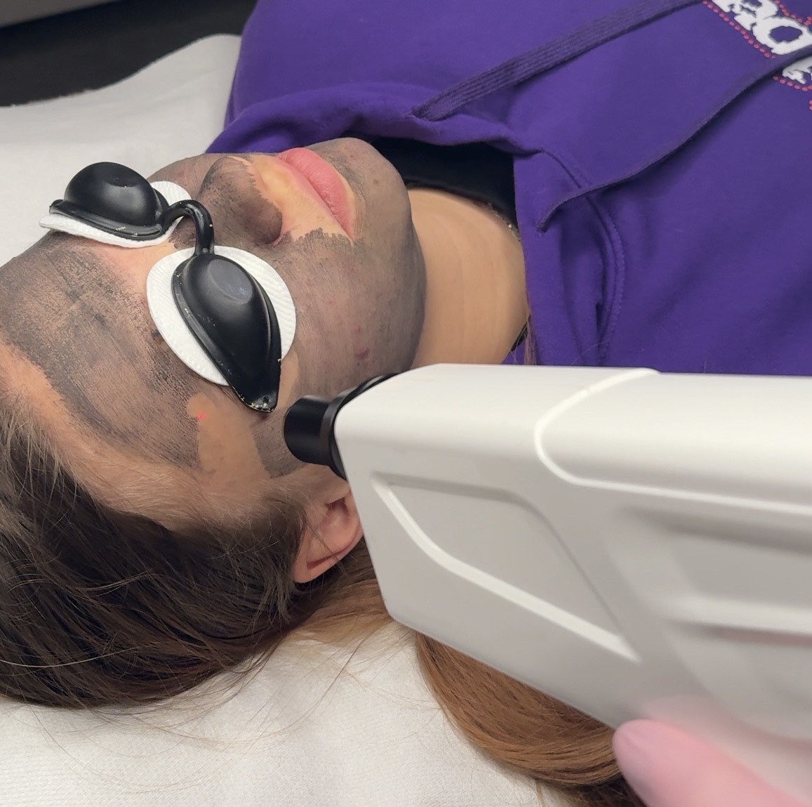 Carbon peeling laserom Piešťany – procedúra, Mya Beauty Studio