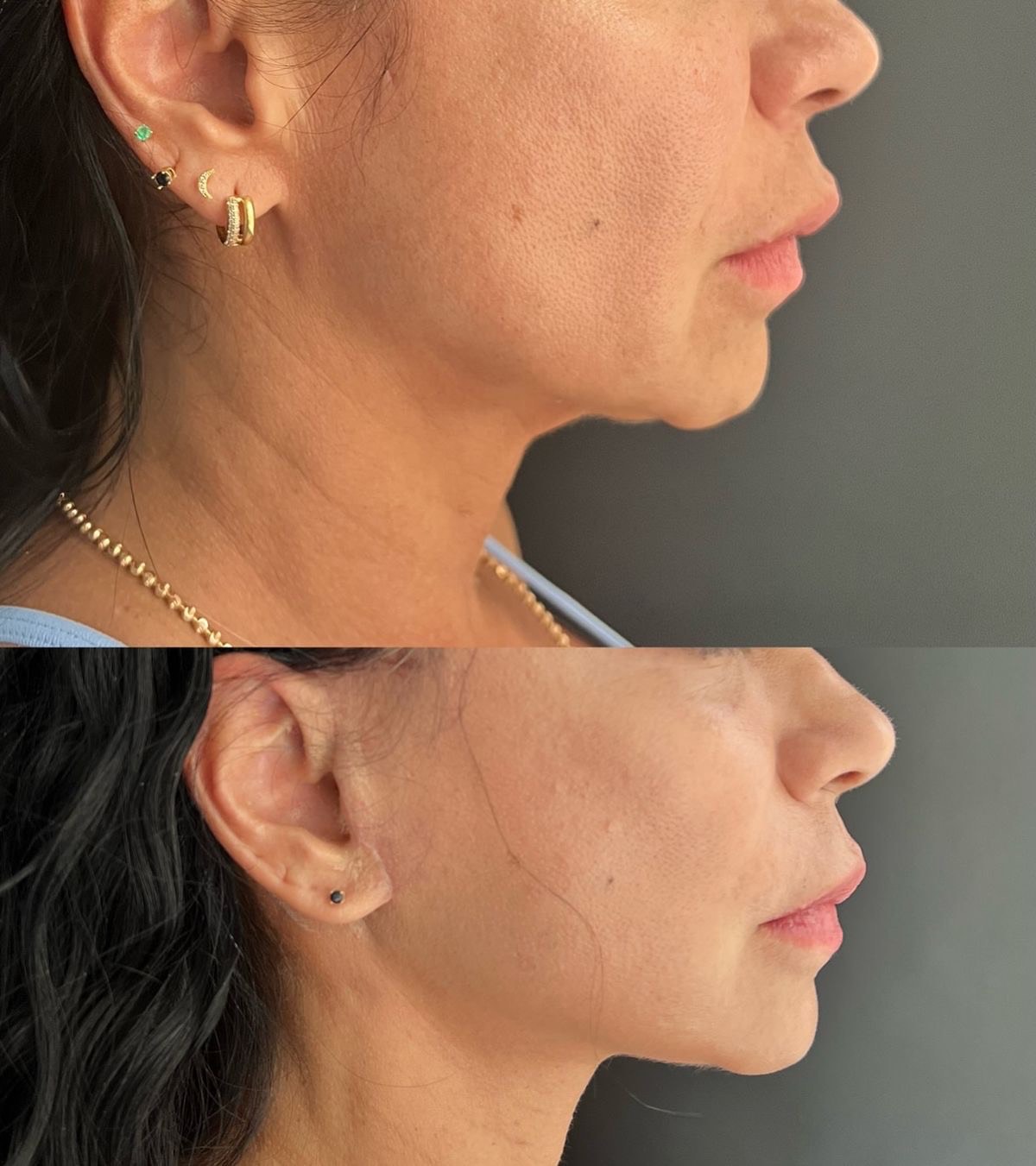 HIFU lifting Piešťany – výsledok pred a po, Mya Beauty Studio