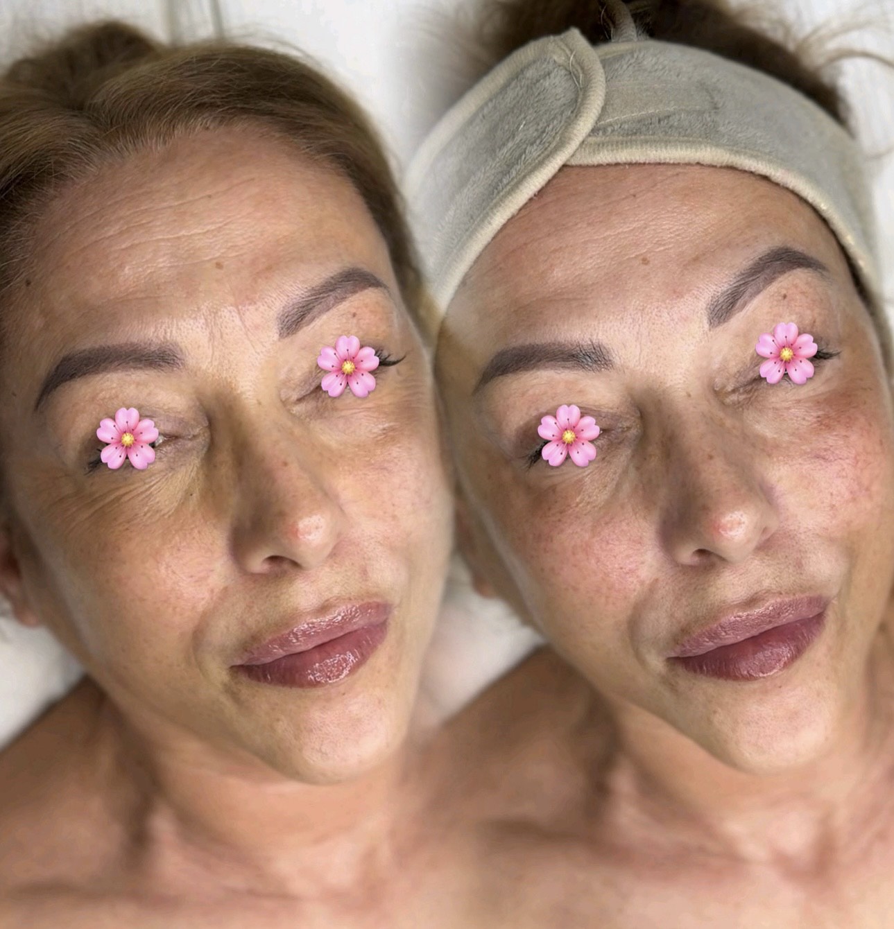 HIFU lifting procedúra Piešťany – Mya Beauty Studio