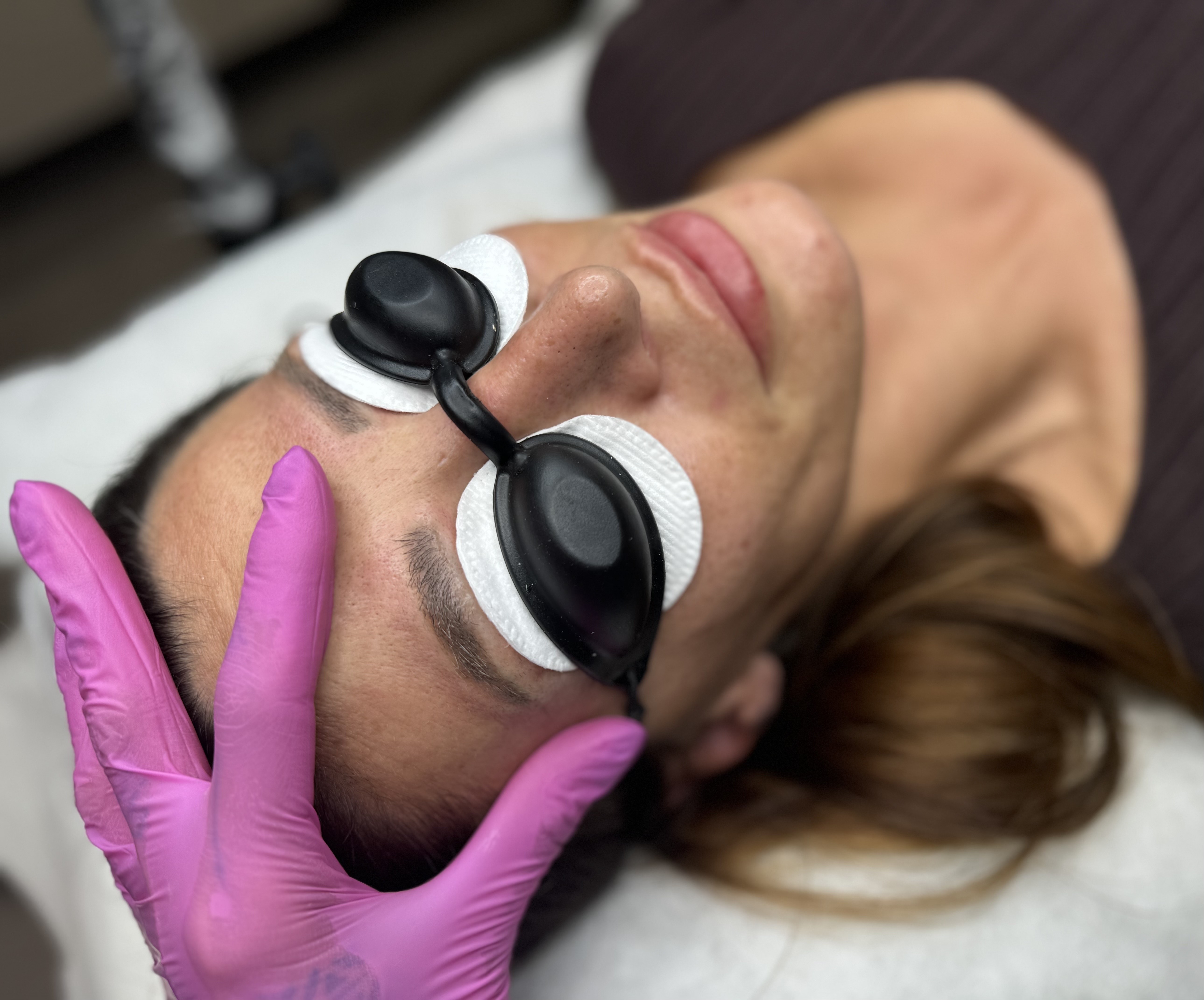 Odstránenie PMU laserom Piešťany – výsledok pred a po